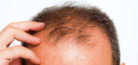 Here Comes A Device To Regrow Hair On Bald Head Odisha Sun Times