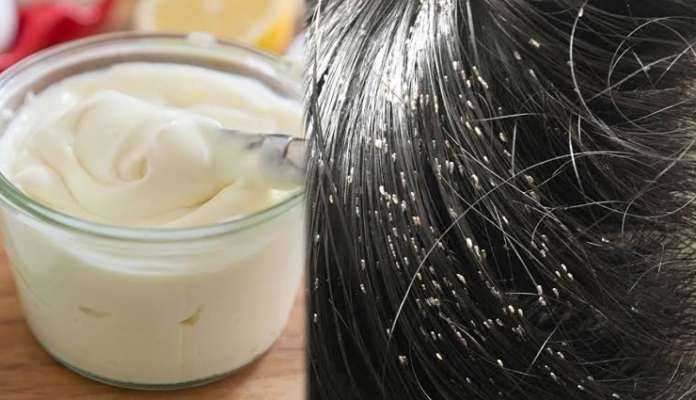 Home Remedies To Get Rid Of Hair Lice Lifeberrys English Dailyhunt