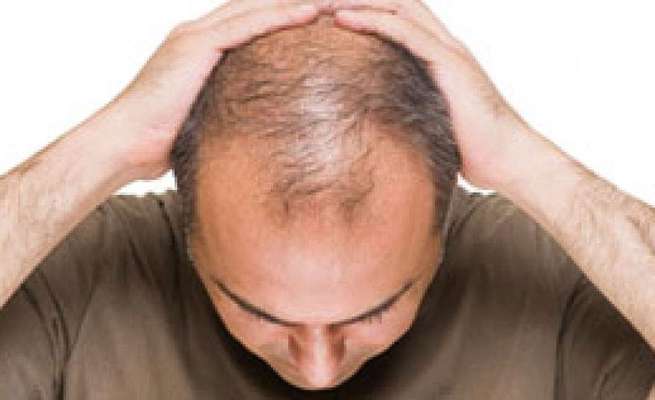 Can Stress Lead To Baldness My Medical Mantra English Dailyhunt