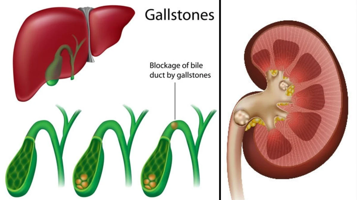 Kidney VS Gallbladder Stones: కిడ్నీ స్టోన్స్, గాల్ బ్లాడర్ స్టోన్స్ రెండింటి లక్షణాలు వేరు, నిర్లక్ష్యం చేయొద