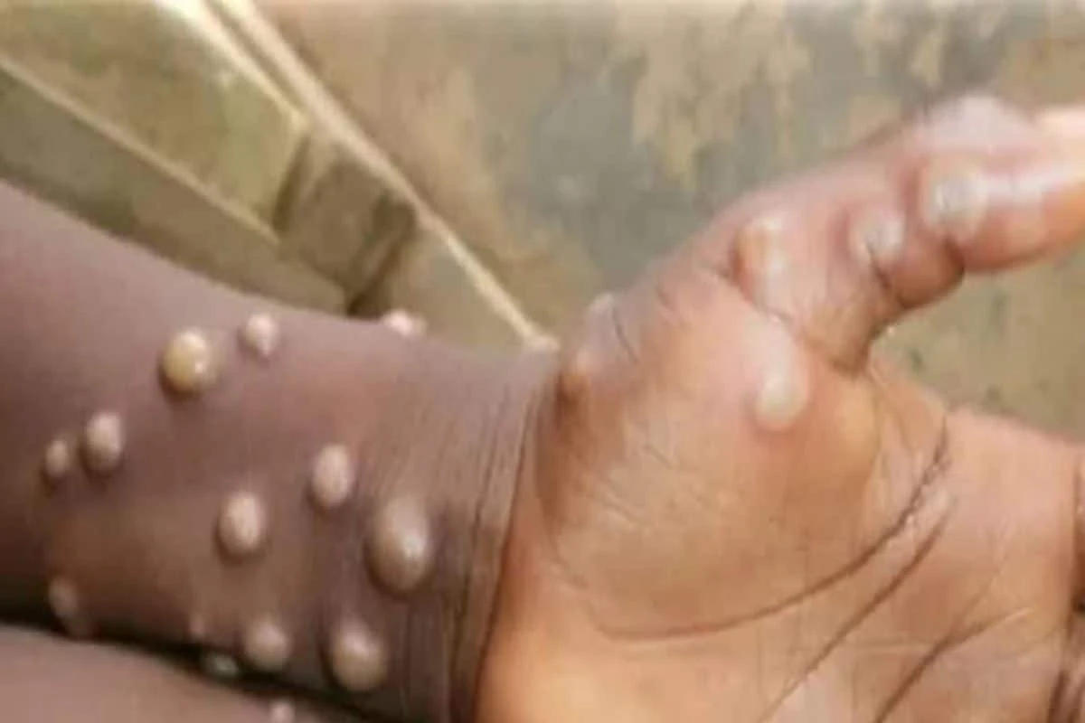 Monkeypox Virus: নয়া আতঙ্ক 'Monkeypox', আগাম তত্‍পরতা রাজ্য স্বাস্থ্য দফতরে! নির্দেশিকা জারি..