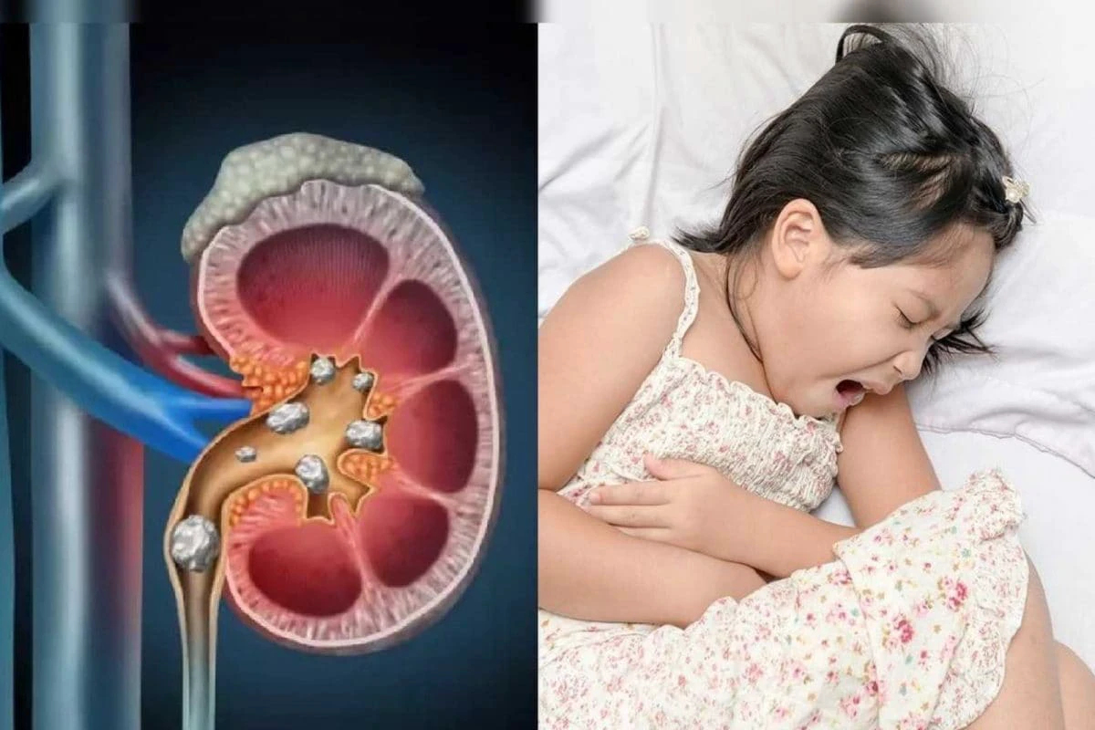 குழந்தைகள் மற்றும் டீனேஜ் பிள்ளைகள் இடையே அதிகரிக்கும் சிறுநீரக கற்கள் பிரச்சனை..! காரணங்கள் என்ன..?