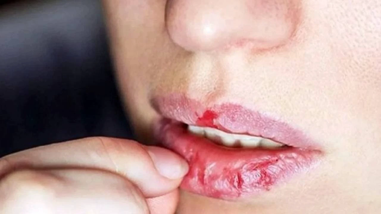 सर्दियों से पहले ही होंठ फट रहे हैं? घर पर करें ये 5 आसान उपाय, एक रात में मिलेंगे मुलायम होंठ