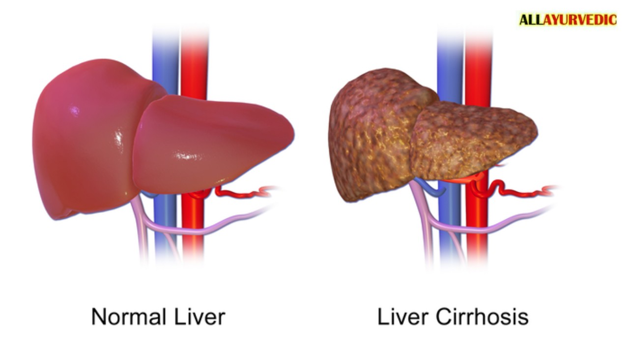 बिना दवां के लिवर की हर बीमारी से मुक्ति पाने का सबसे आसान घरेलु उपाय--
