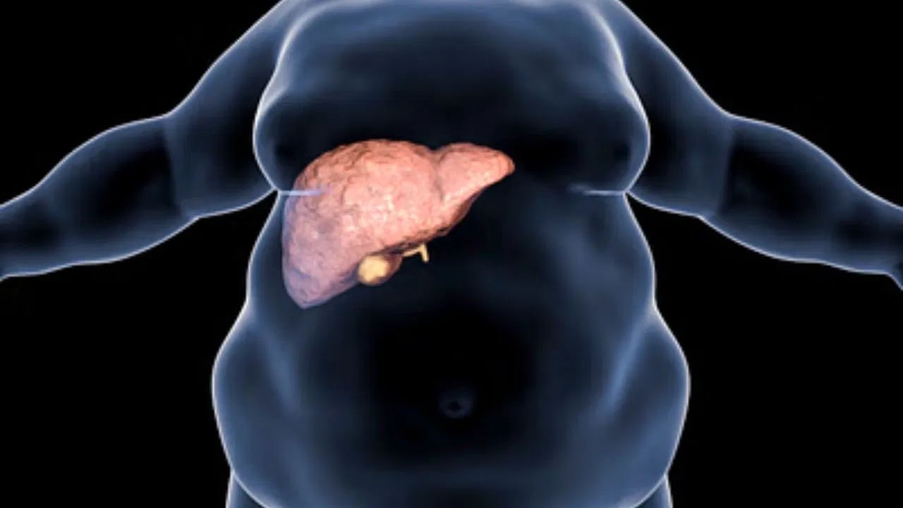 Fatty Liver: శరీరంలో ఈ లక్షణం కనిపిస్తే మీకు ఫ్యాటీ లివర్‌ సమస్య ఉన్నట్లే.. బీ కేర్‌ ఫుల్‌