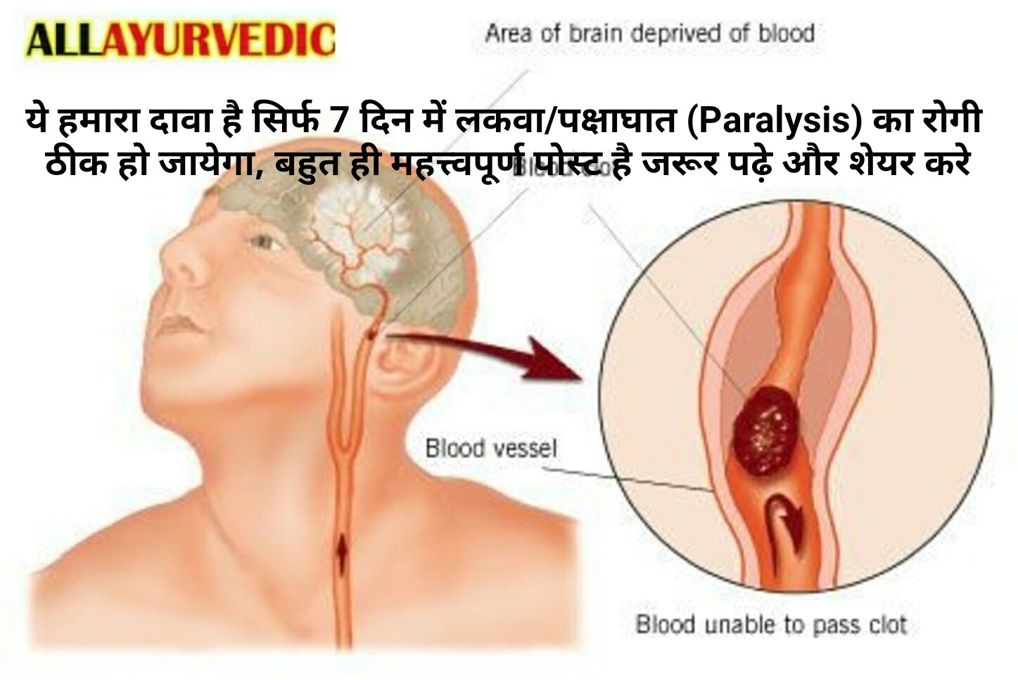 ये हमारा दावा है कि सिर्फ 7 दिन में लकवा/पक्षाघात (PARALYSIS) का रोगी ठीक होगा वो भी निःशुल्क, बहुत ही महत्त्वपूर्ण पोस्ट है जरूर पढ़े और शेयर करे.,.