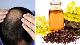 வழுக்கை பிரச்னைக்கு கடுகு எண்ணெய் போதுமே!