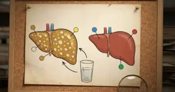 Fatty Liver में राहत के लिए 4 आसान आदतें, जानें कौन से घरेलू विकल्प हो सकते हैं मददगार