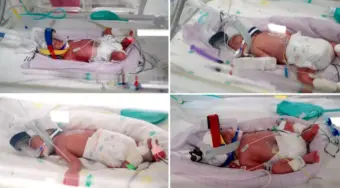 Identical Quadruplets: ୨ କି ୩ ନୁହେଁ. ଏକାସାଙ୍ଗରେ ଜନ୍ମକଲେ ୪ ଝିଅ! ଅବିକଳ ଦେଖିବାକୁ ପୂରା ଏକା.