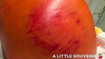 Rishabh Pant Shares Picture Of Bruised Shoulder After Sri Lanka Test, Calls It 'A Little Souvenir'