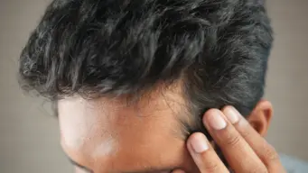 Hair loss in young men : చిన్న వయస్సులోనే రాలిపోతున్న జుట్టు.. కారణం ఏంటి? ఆపేదెలా?