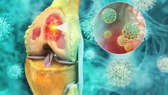 Sarcoma: All you need to know