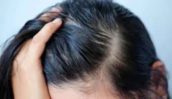 12 Home Remedies To Treat Oily Scalp