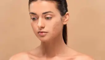 10 Home Remedies To Treat Patchy Skin
