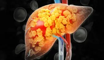 8 Home Remedies To Support Fatty Liver