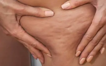 Cellulite | సెల్యులైట్ అంటే ఏమిటి.. ఇది ఎవరికి వస్తుంది.. తగ్గాలంటే ఏం చేయాలి..?