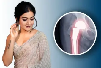 রশ্মিকা মন্দানার হিপ ইনজুরি: মেদহীন চেহারা ও ফিটনেসের আড়ালেও লুকিয়ে থাকে বিপদ, কী ঘটে টেন্ডন ছিঁড়ে গেলে, বললেন চিকিৎসক
