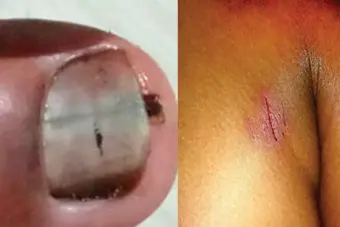 12-yr-old Kerala boy faces savage torture with chilli in eyes, toothpicks under nails; kin booked