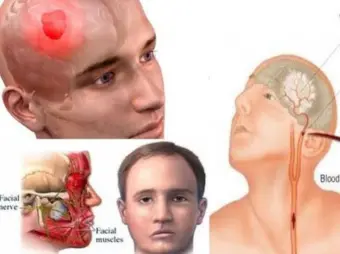 पैरालायसिस अटैक' के पहले कुछ सेकेंड में करें ये 1 काम जीवन भर के लिए बच सकते हैं'...