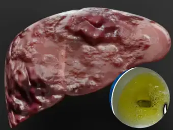 पेशाब के रंग से 'समझें लिवर' सड़ना हो गया शुरू Liver से विषाक्त निकालने' के लिए खाएं.