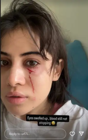 Blood on face, swelling under eyes; What exactly happened to Urfi? Video viral 9 Blood on face, swelling under eyes; What exactly happened to Urfi? Video viral