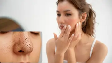 Blackheads Removal Tips: चेहऱ्यावरील हट्टी ब्लॅकहेड्सना करा बाय-बाय; 'हे' सोपे उपाय ठरतील फायदेशीर