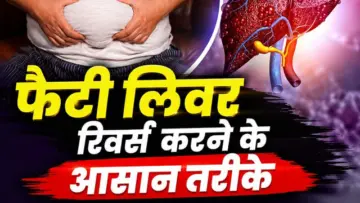 फैटी लिवर की अनदेखी पड़ सकती है भारी! जानिए लक्षण, हेल्थ को खतरा और रिवर्स करने के असरदार तरीके