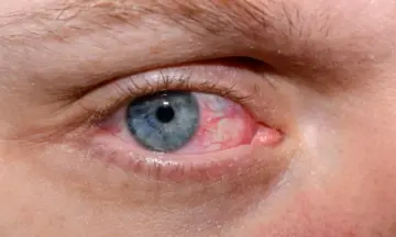 Dry Eye Disease Rising Due to Screen Time, Doctors Warn