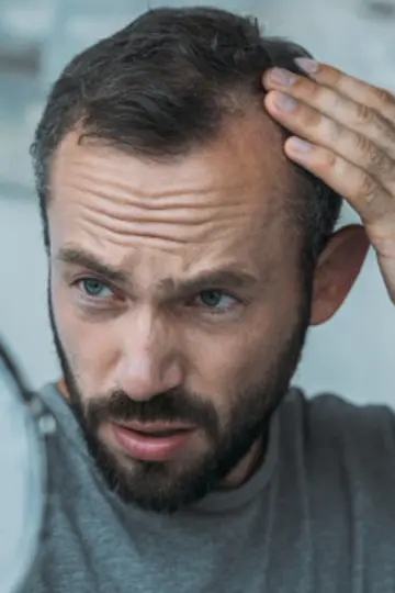 The Most Effective Topical Treatments for Advanced Hair Loss