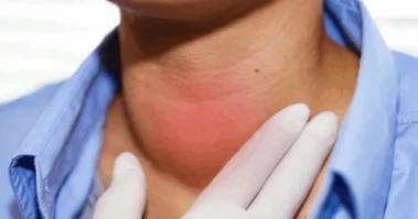 Weight Gain After 35 May Indicate Thyroid Dysfunction, Experts Say