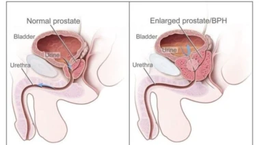 Doctors treat 77-year-old man with enlarged prostate using minimally invasive laser surgery in Delhi