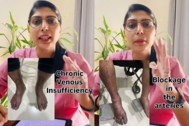 Leg Discoloration: AIIMS Doctor Warns This Simple Looking Vein Issue Could Hide A Bigger Health Risk, Check Video