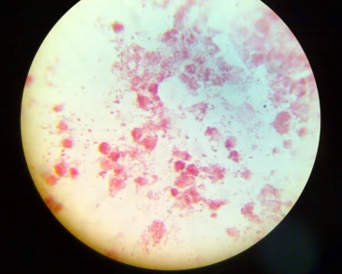 Gonorrhea and syphilis cases hit record highs in Europe due to changing sexual habits and testing