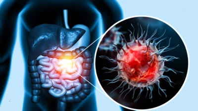 Colorectal Cancer: UK Surgeon Warns Of 5 Silent Signs You Shouldn't Ignore