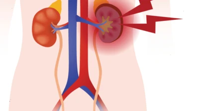 Why Kidney Stones Are Rising Among Young Children