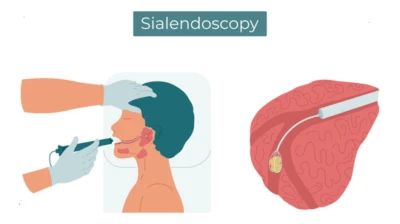 Tiny Stones, Big Pain: How Modern Endoscopy Is Saving Salivary Glands