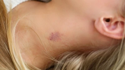 'Kiss Of Death': Can A Passionate Hickey Turn Fatal?