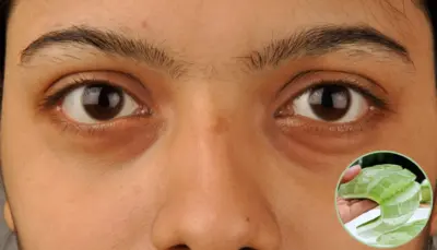 5 Aloe Vera Remedies To Remove Dark Circles