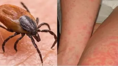 Scrub typhus: ଅନୁଗୁଳ ପାଲଲହଡ଼ାରେ ସ୍କ୍ରବ୍ ଟାଇଫସ୍ ଆତଙ୍କ, ଜଣଙ୍କ ମୃତ୍ୟୁ ଅଭିଯୋଗ