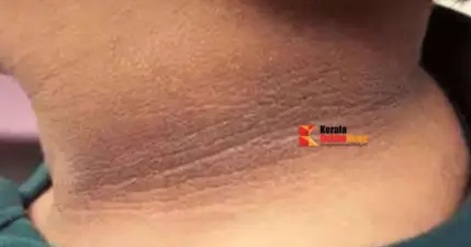 കഴുത്തിന് ചുറ്റുമുള്ള കറുപ്പ് നിറം അകറ്റാം ; ഈ പാക്കുകള് പരീക്ഷിക്കൂ...