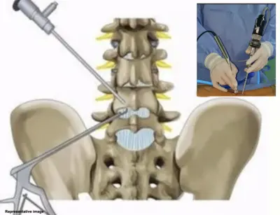 NIMS Doctors Remove Spinal Tumour Using Minimally Invasive Technique