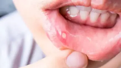 Mouth Ulcer: చిన్న నోటిపుండే కదా అని లైట్ తీసుకుంటున్నారా? ఈ మార్పులు కనిపిస్తే తప్పక డాక్టర్ను సంప్రదించాల్సిందే.!