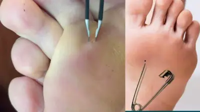 முள்ளை முள்ளால் எடுப்பது எப்படி? வியக்க வைக்கும் அறிவியல் உண்மைகள்!