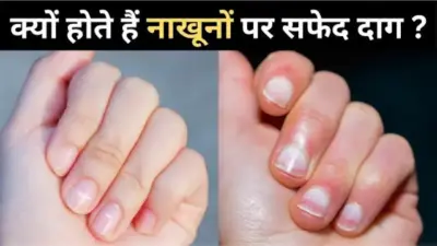 सफेद दाग सिर्फ' कैल्शियम की कमी नहीं, जानिए नाखूनों के इन संकेतों का असली मतलब'