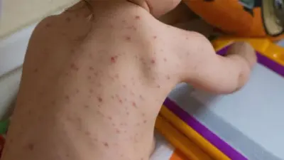 A summer of fevers and rashes: Why chickenpox cases are increasing in Chennai