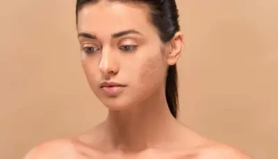 10 Home Remedies To Treat Patchy Skin