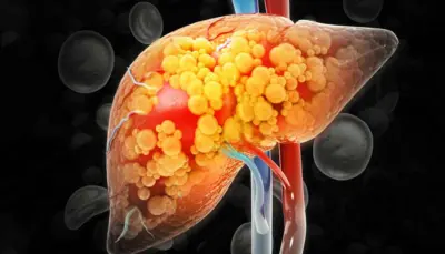 8 Home Remedies To Support Fatty Liver