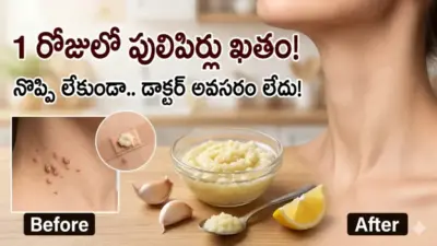 కేవలం 1 రోజులో పులిపిర్లు మాయం.. డాక్టర్తో పనిలేకుండా ఇంట్లోనే ఇలా చెక్ పెట్టండి!