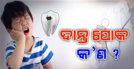 ଦାନ୍ତ ପୋକ କାଟିବା (Tooth Decay) କ'ଣ ? ଏହାର କାରଣ, ଲକ୍ଷଣ ଓ ଚିକିତ୍ସା ସମ୍ବନ୍ଧରେ ଆସନ୍ତୁ ଜାଣିବା ଦାନ୍ତରୋଗ ବିଶେଷଜ୍ଞ Dr. Harsh Mohan Pathak ଙ୍କ ଠାରୁ