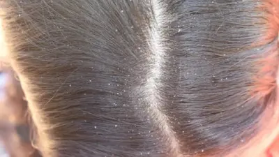 From Winter Dryness To Summer Sweat: How to Prevent Seasonal Dandruff Flare-Ups